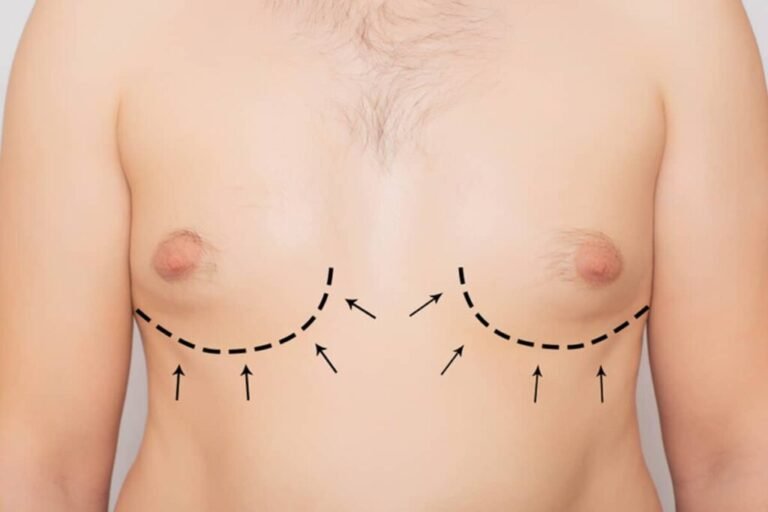 Gynecomastia Grades Explained:Grade 1, 2, 3 & 4