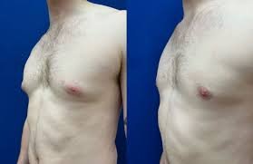 VASER Lipo vs Gland Excision: Which Gynecomastia Technique Do You Need?